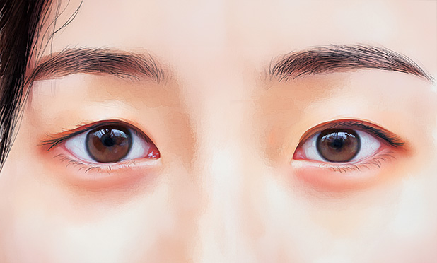 퀵 매몰 재수술(낮은쌍꺼풀) 케이스